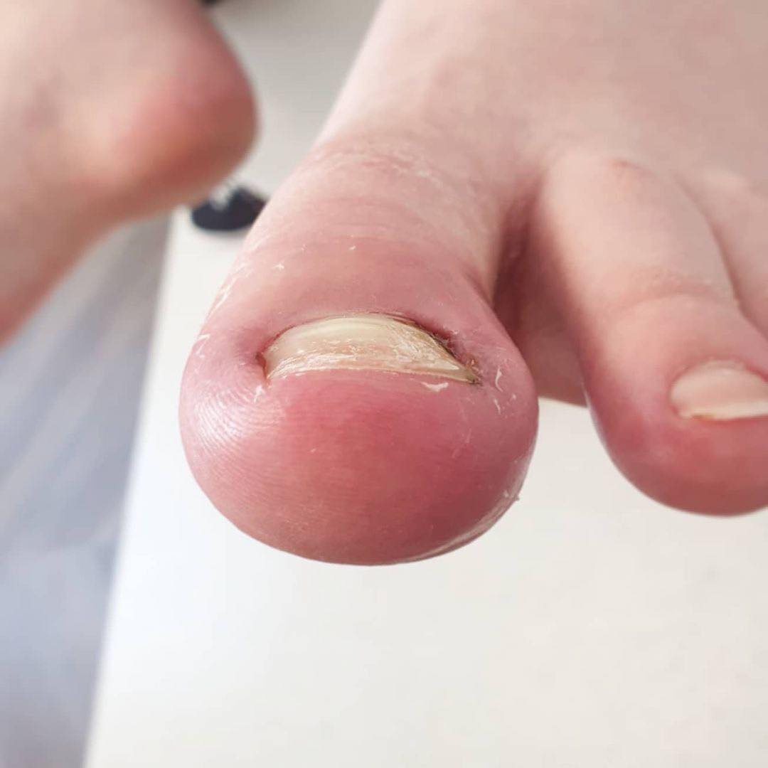 Ingrown Nail