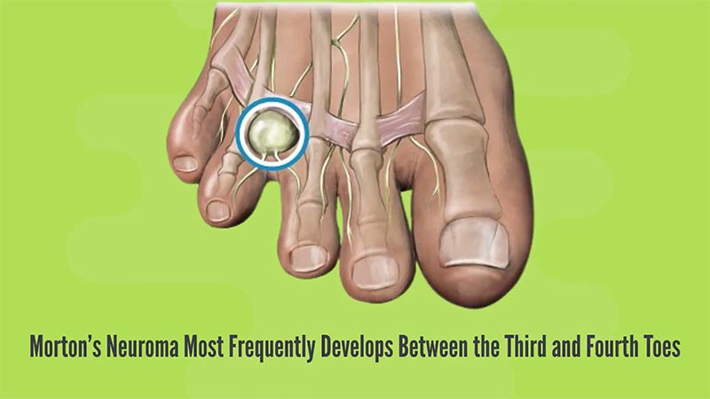Mortons Neuroma