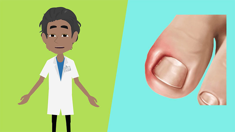 Ingrown Nail Treatment