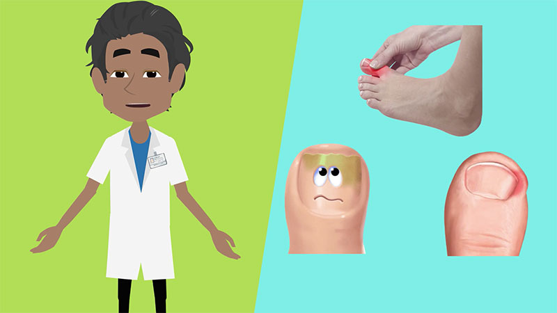 Treatment of Ingrown Nail