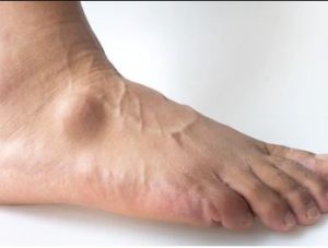 Flat Feet Treatment