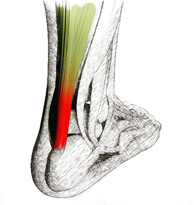 Understanding Achilles Tendinitis: Symptoms and Diagnosis