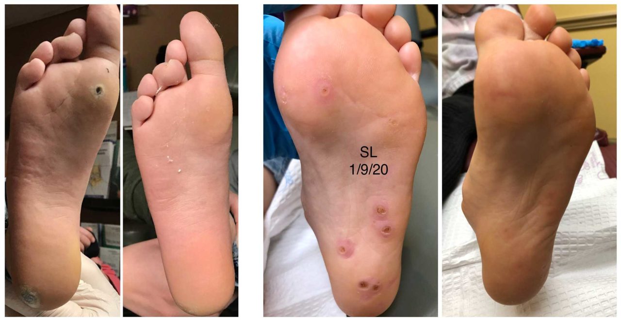 Dying Plantar Wart Pictures Flagstaff Foot Doctors